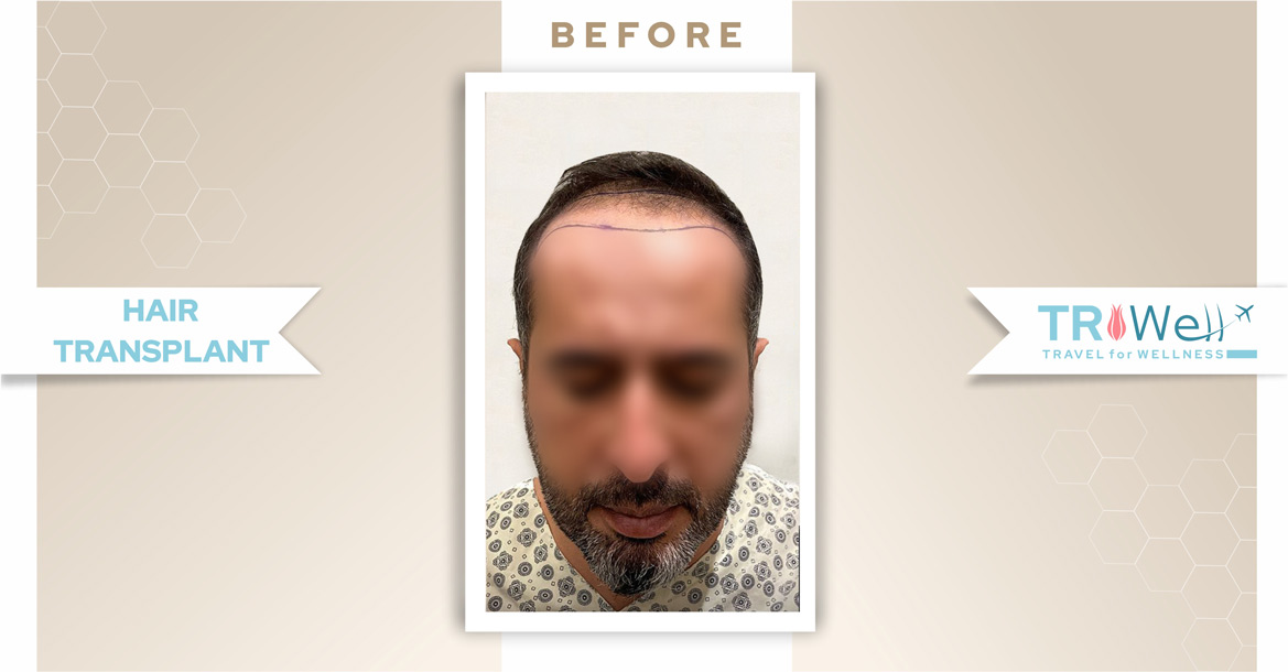 Before-Hair Transplant